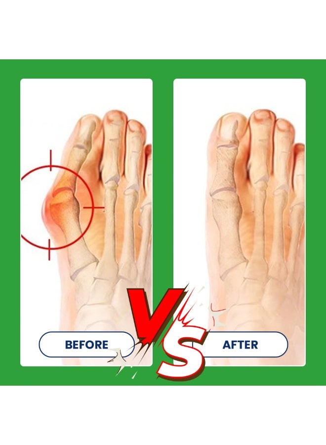 سوميفون مرهم النقرس 3 قطع، كريم موضعي لتخفيف آلام وتورم النقرس، لعدم الراحة في المفاصل بالأصابع، وأصابع القدم، والكتفين - Image 3